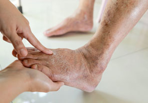 Peripheral Arterial Disease