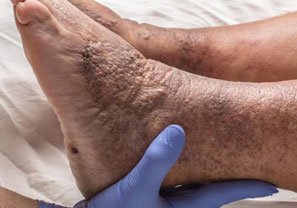 Deep Vein Thrombosis (DVT)
