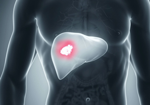 Liver Cancer