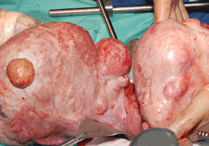 Uterine Fibroids